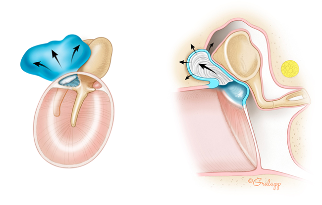 Cholesteatoma