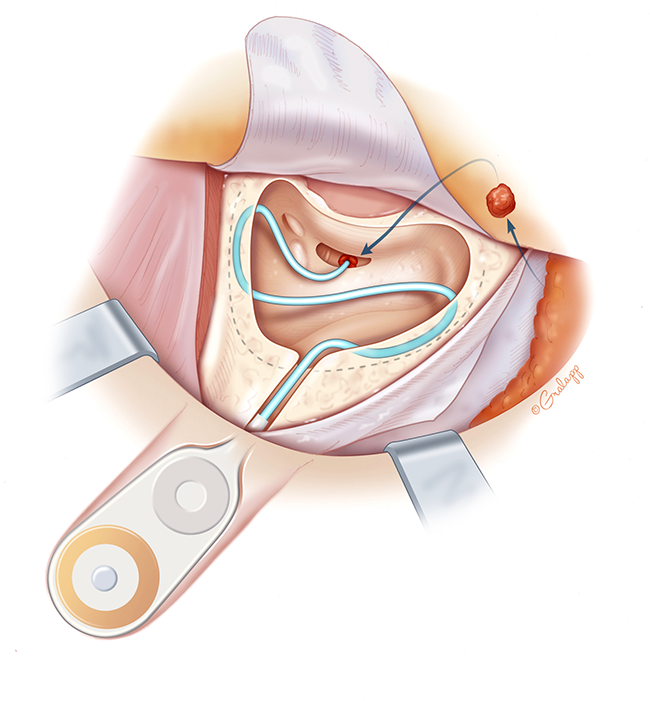 cochlear3