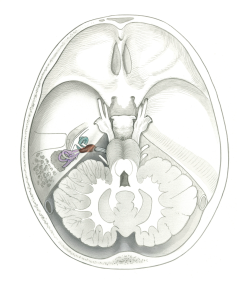 Neuroma1