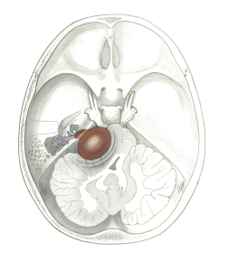 Neuroma2