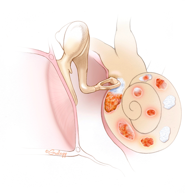 Otosclerosis